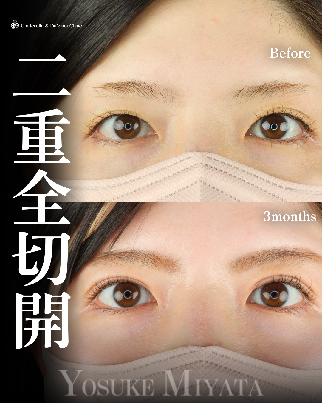 埋没から全切開へ