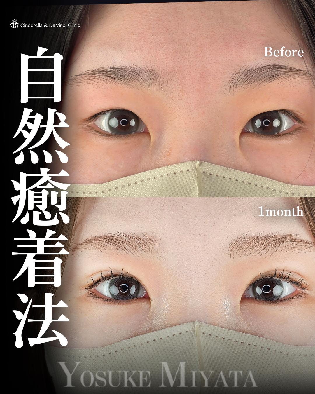 可愛らしい二重