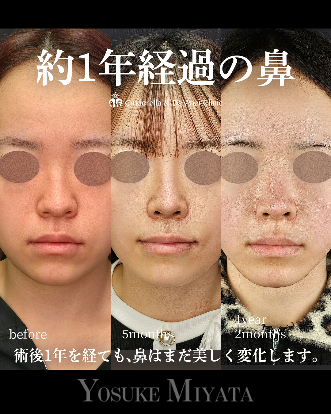 1年2ヶ月経過の鼻