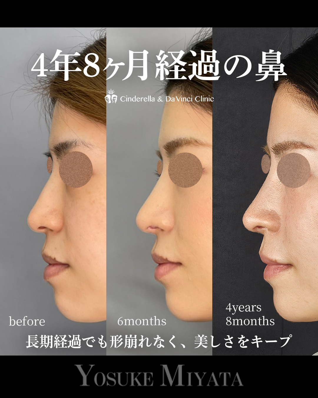 4年以上経過の鼻