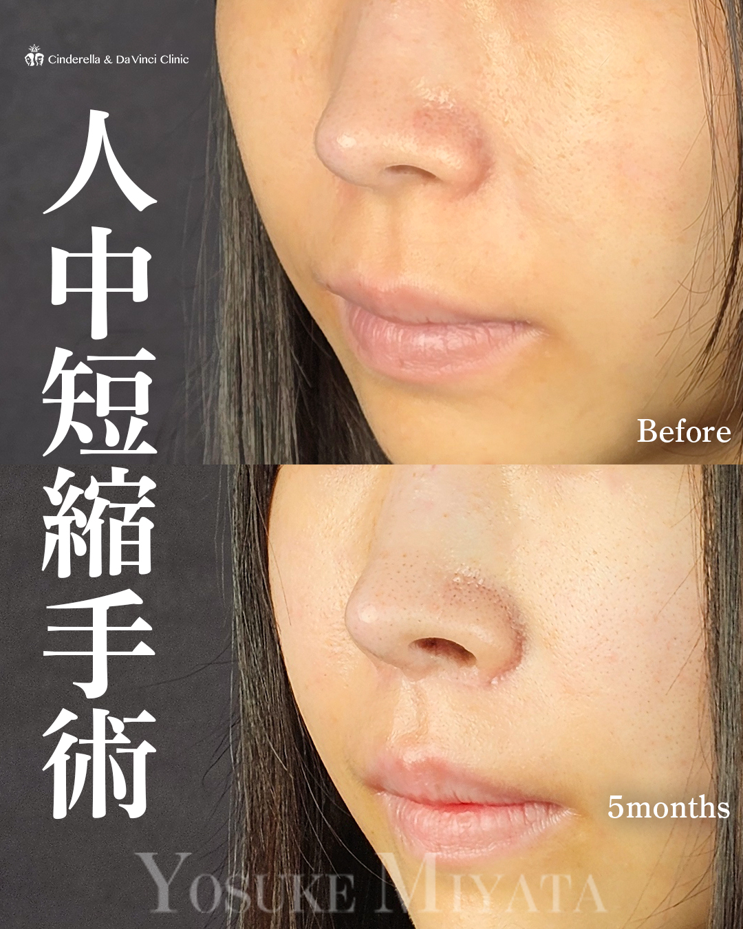 人中短縮で中顔面も短縮