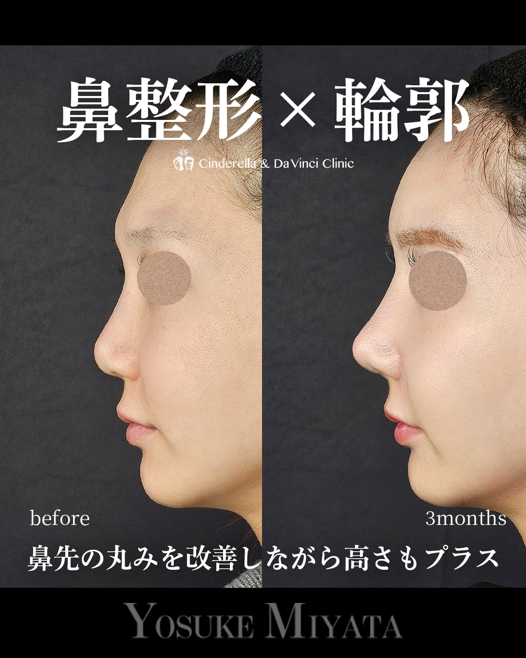 鼻整形×輪郭の画像