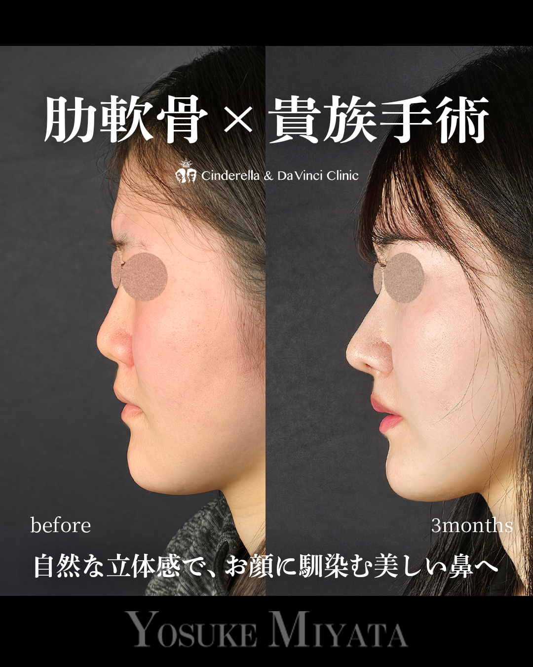 小鼻を小さく見せるの画像