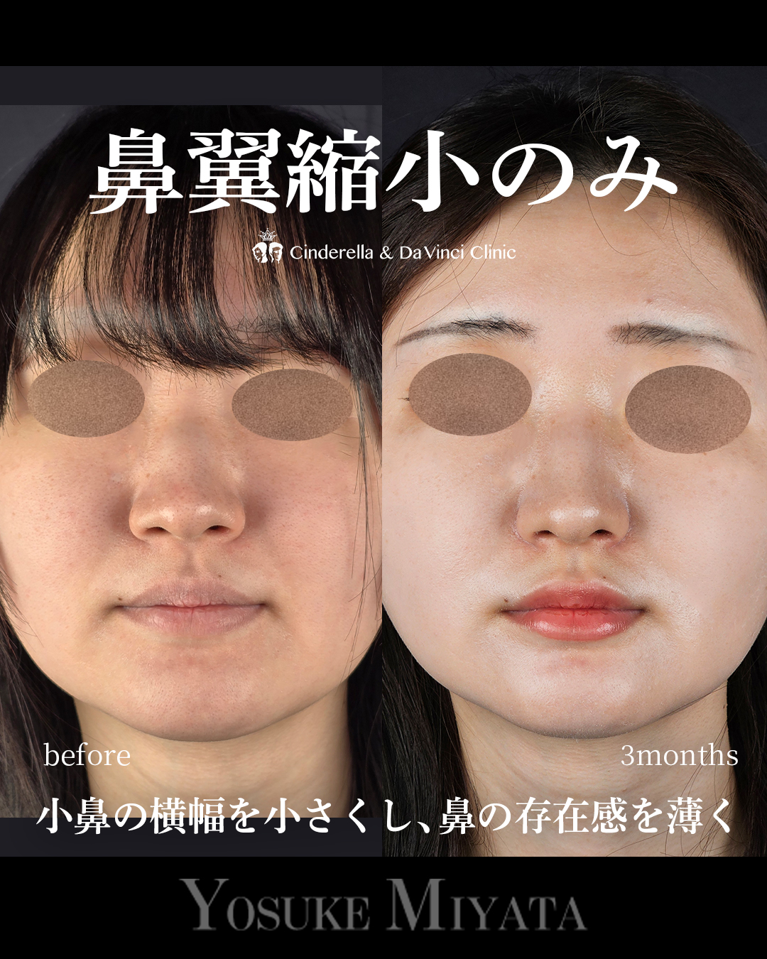 小鼻縮小のみで鼻の存在感をなくすの画像