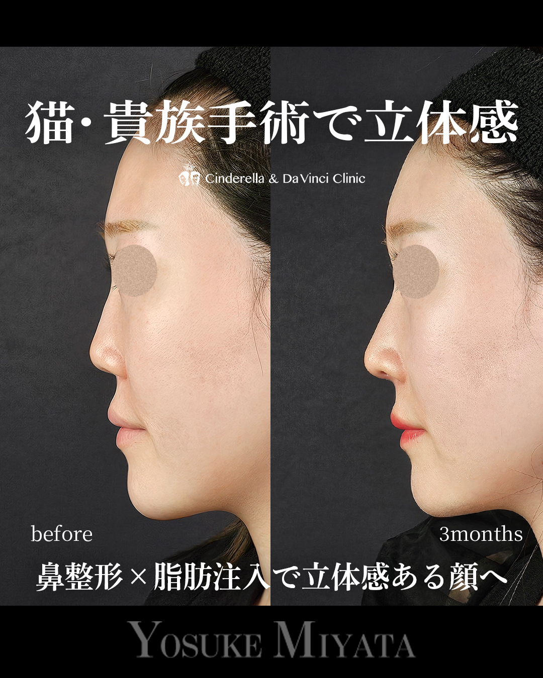 顔に立体感を出すの画像