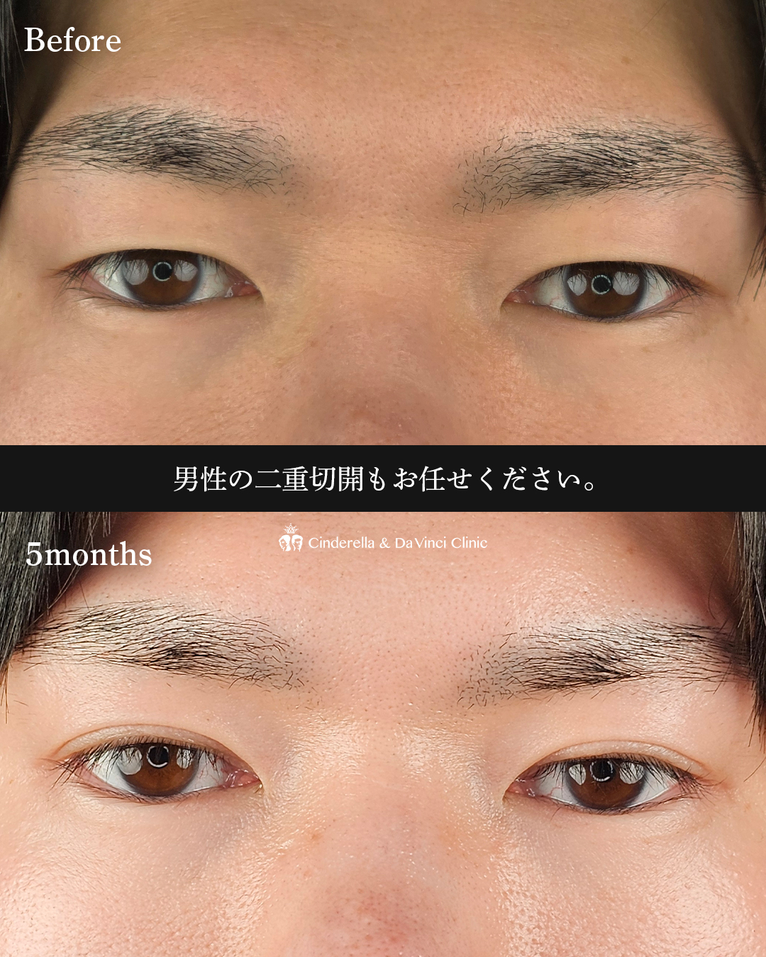 男性の二重切開の画像