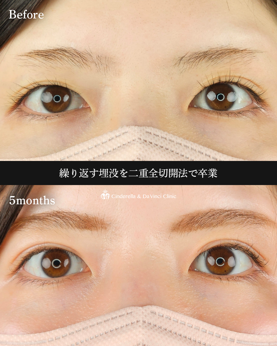 埋没から全切開への画像