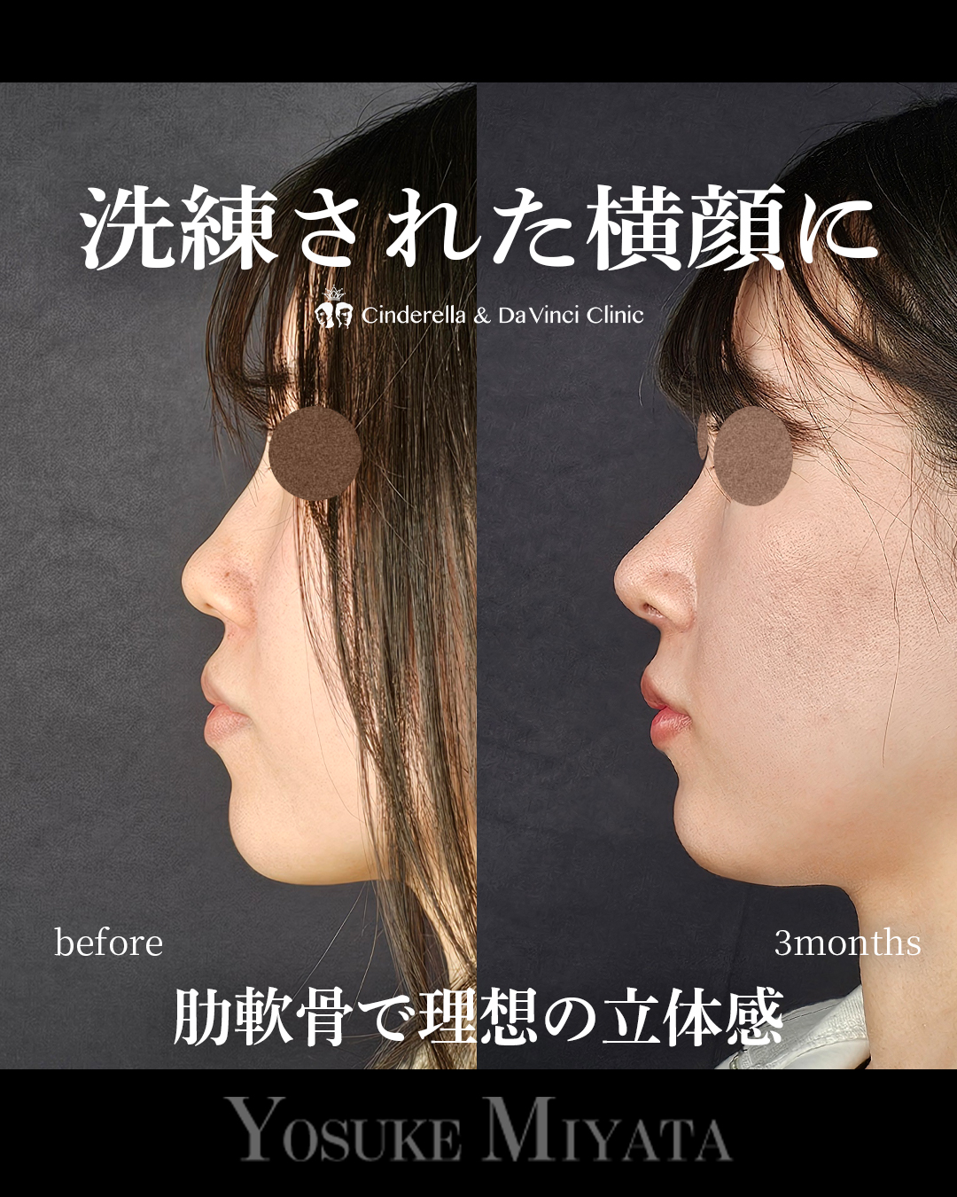 鼻整形で横顔をきれいにするの画像