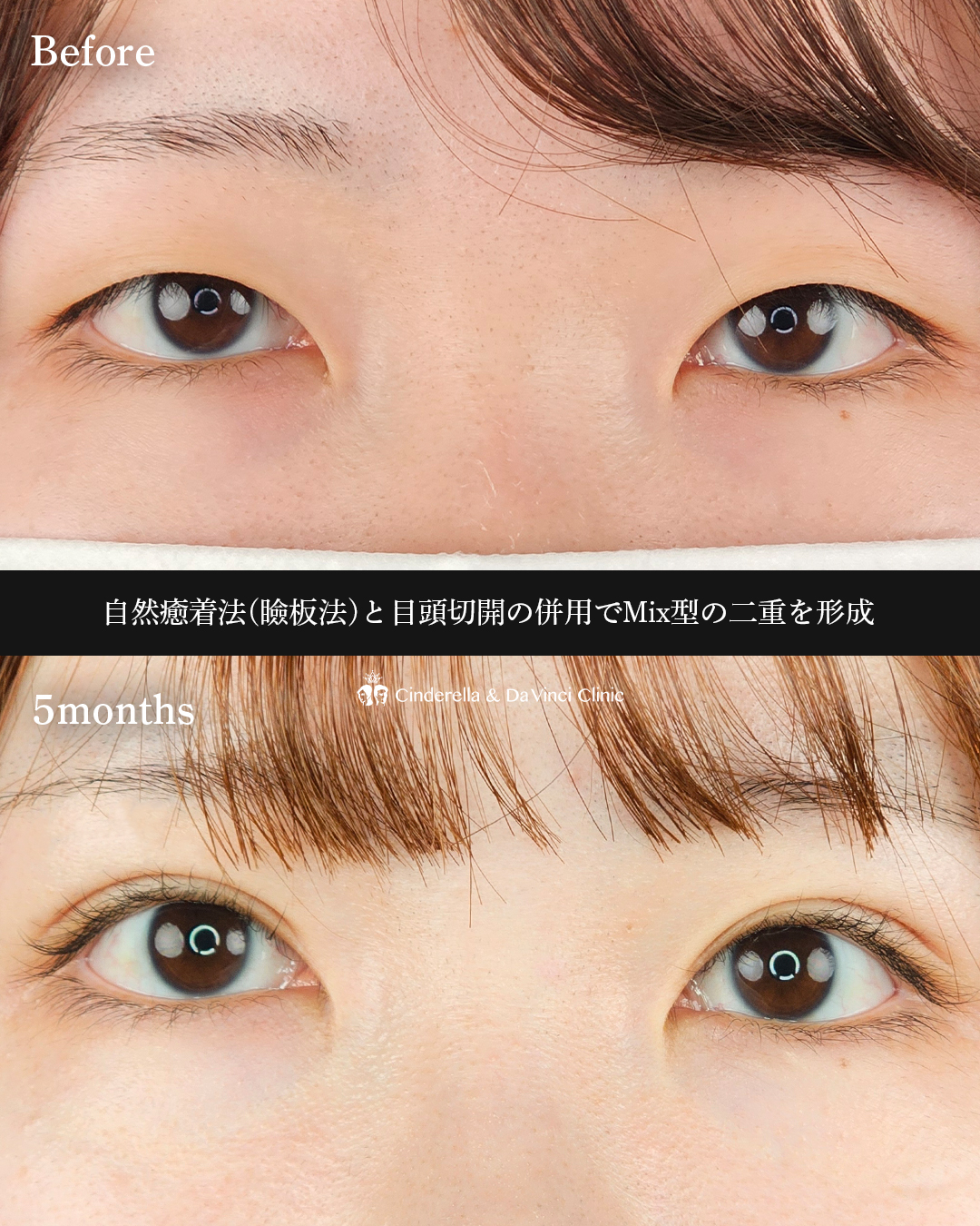 理想のMix型への画像