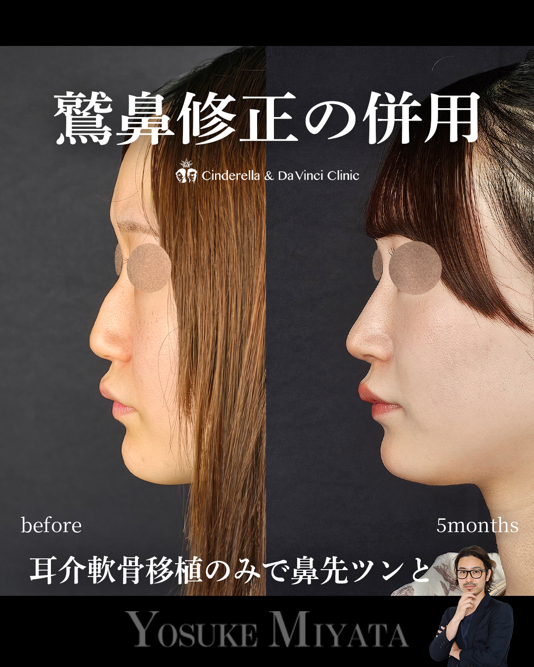 鷲鼻修正の併用の画像