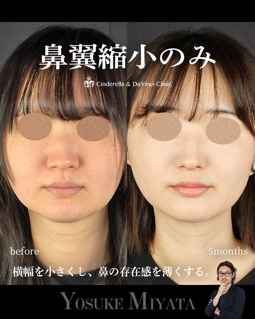 小鼻縮小のみで鼻の存在感をなくすの画像