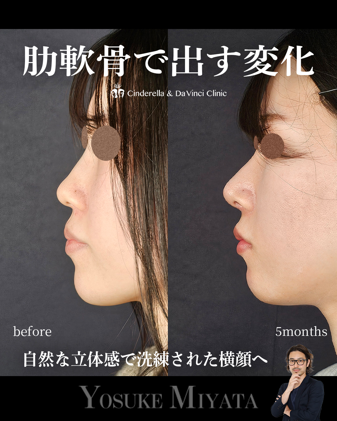鼻整形で横顔をきれいにするの画像