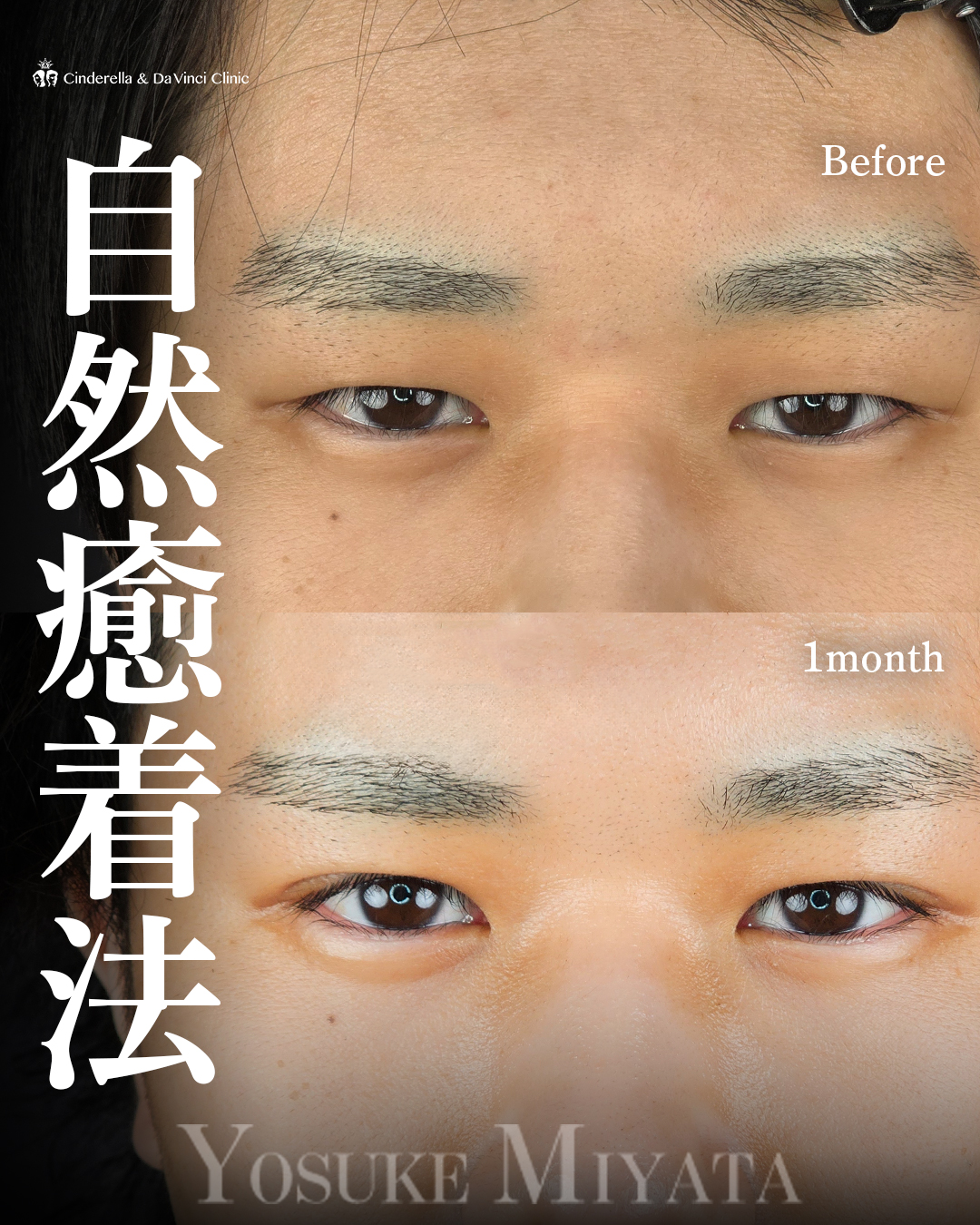 自然な二重埋没