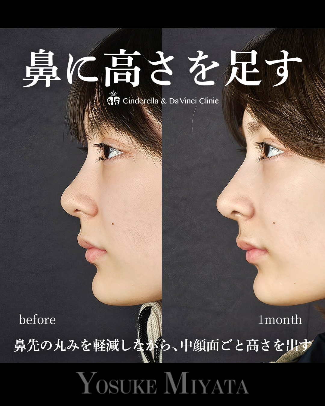 鼻に高さを足す