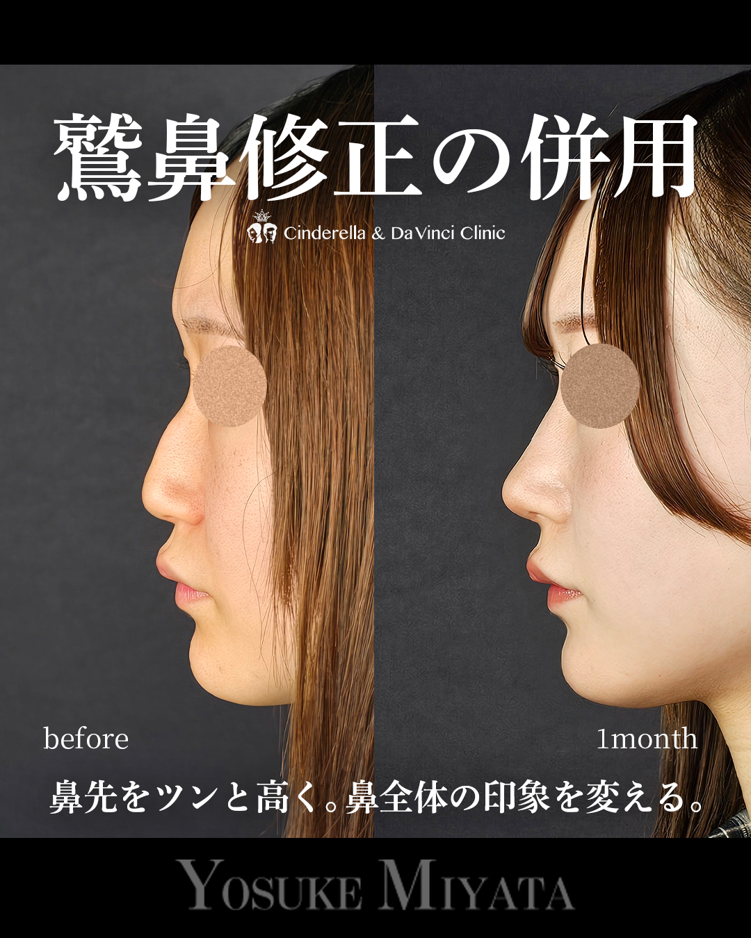 鷲鼻修正の併用