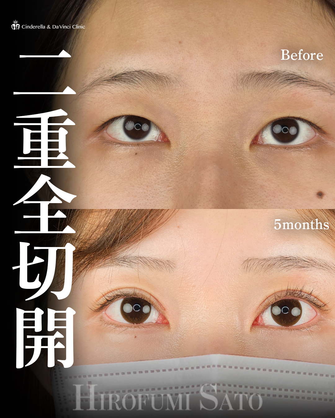 切開でつくる二重