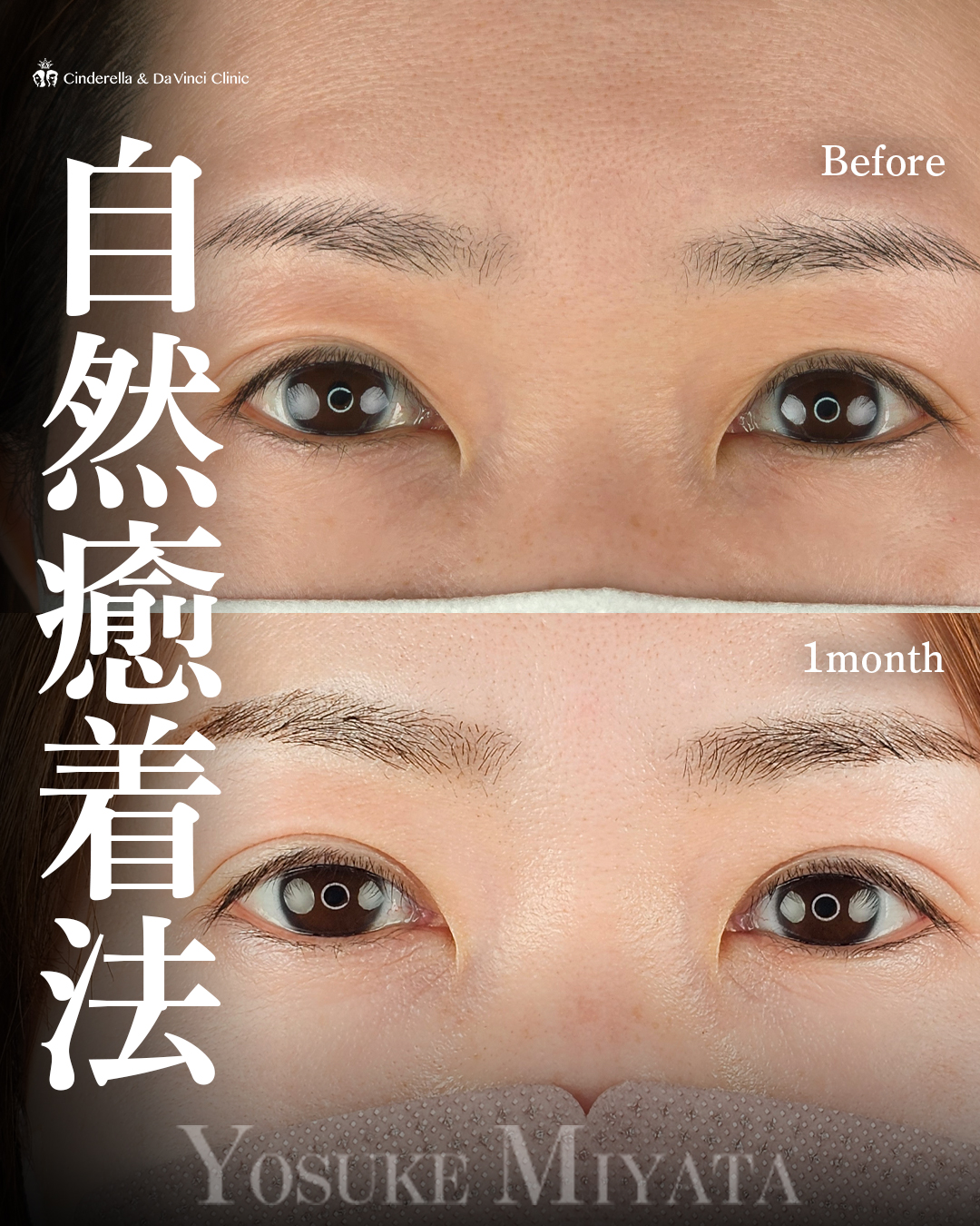 左右差の無い二重