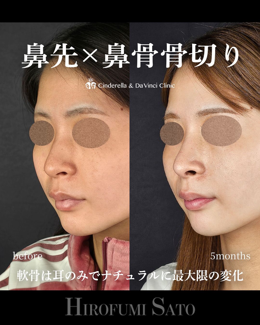 ナチュラルな鼻整形の画像