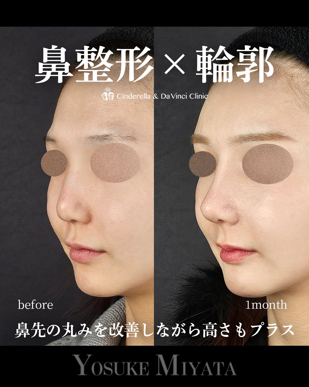 鼻整形×輪郭の画像