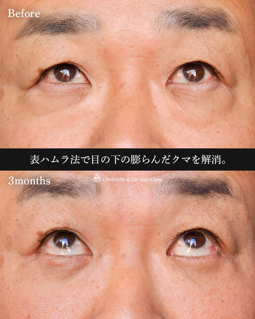 表ハムラでクマ解消の画像