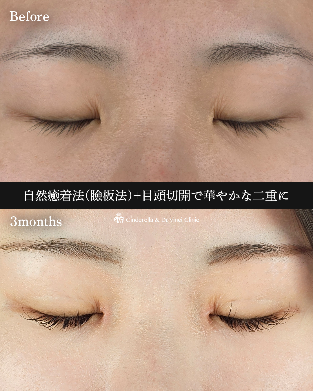 目頭併用で華やか目の画像