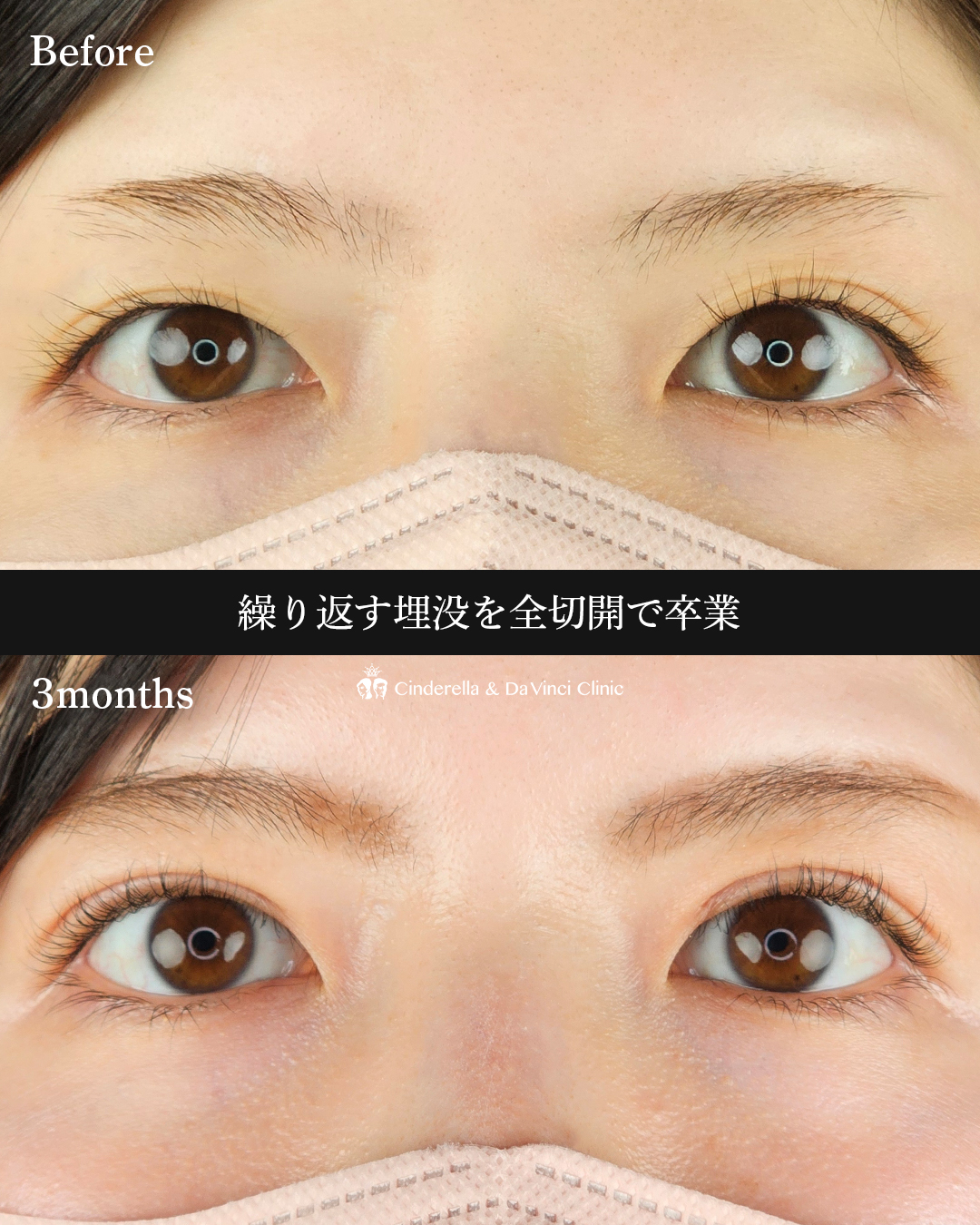 埋没から全切開への画像