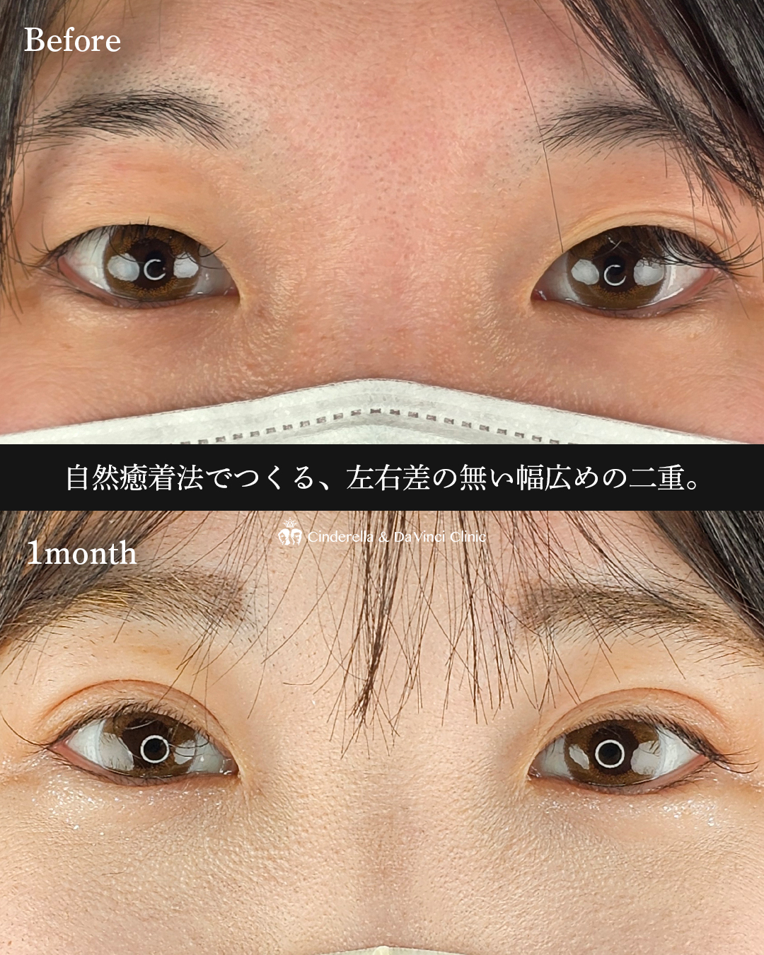 幅広二重の画像