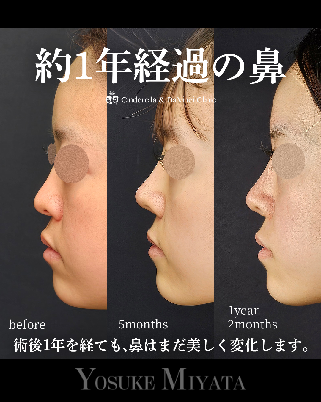 1年2ヶ月経過の鼻の画像