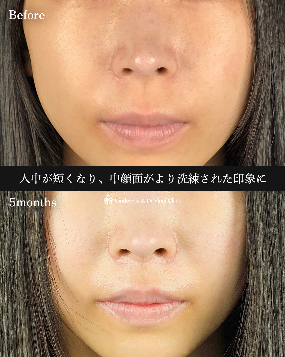 人中短縮で中顔面も短縮の画像