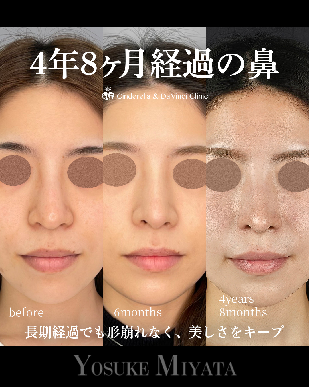 4年以上経過の鼻の画像