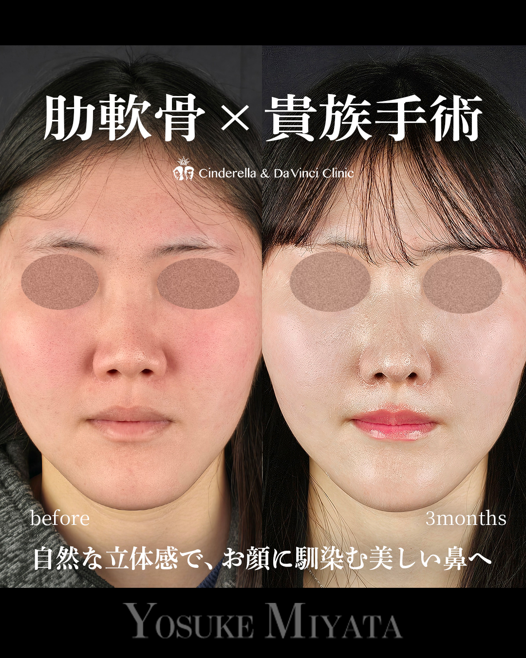 小鼻を小さく見せるの画像