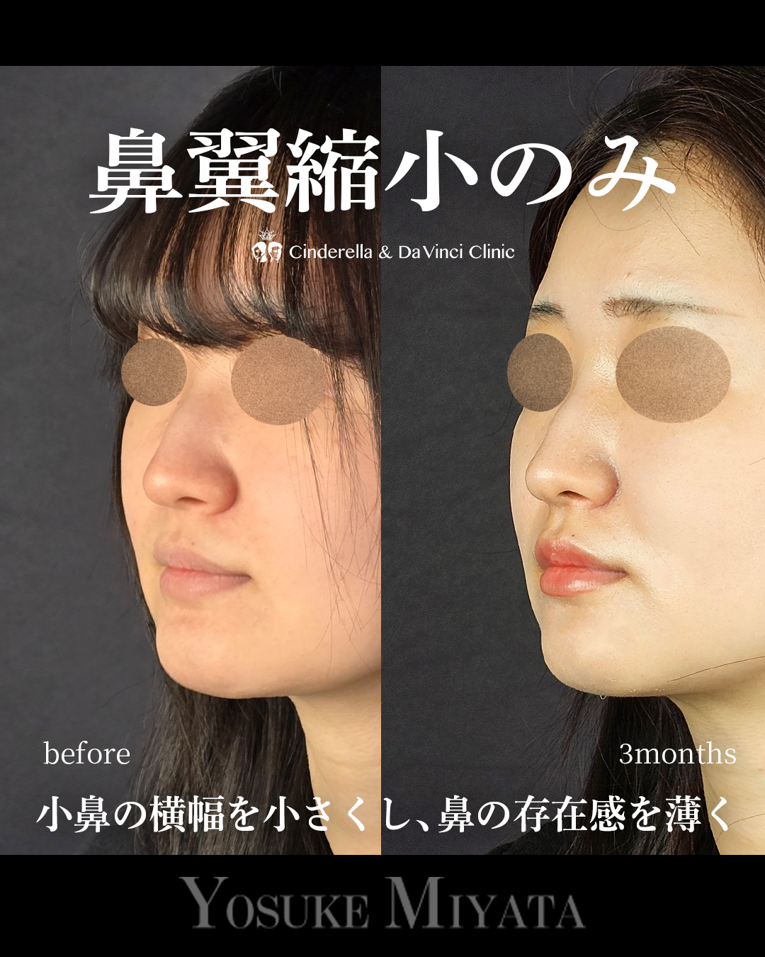 小鼻縮小のみで鼻の存在感をなくすの画像