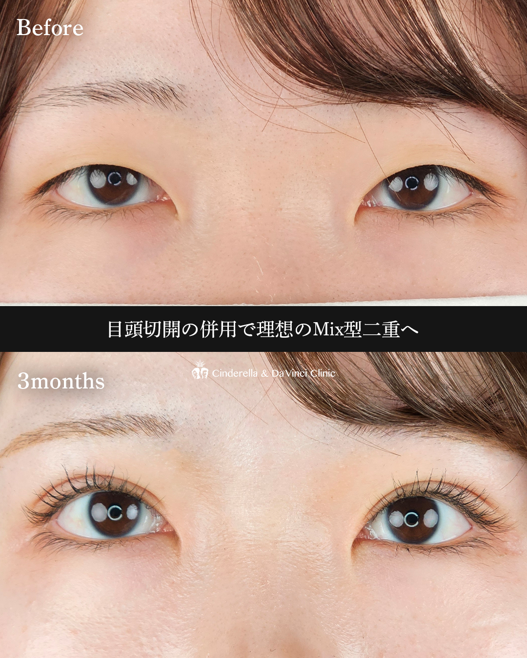 理想のMix型への画像