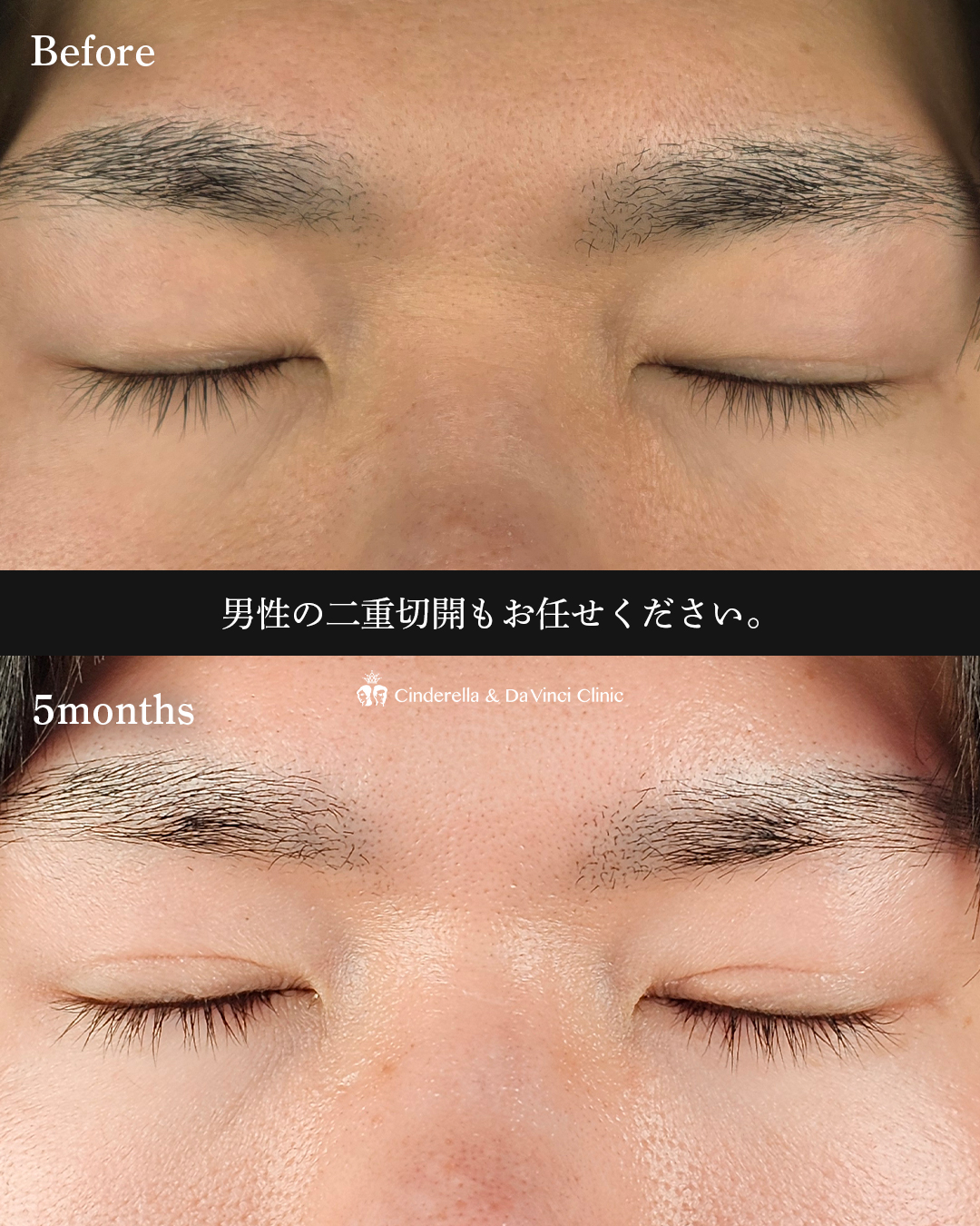 男性の二重切開の画像