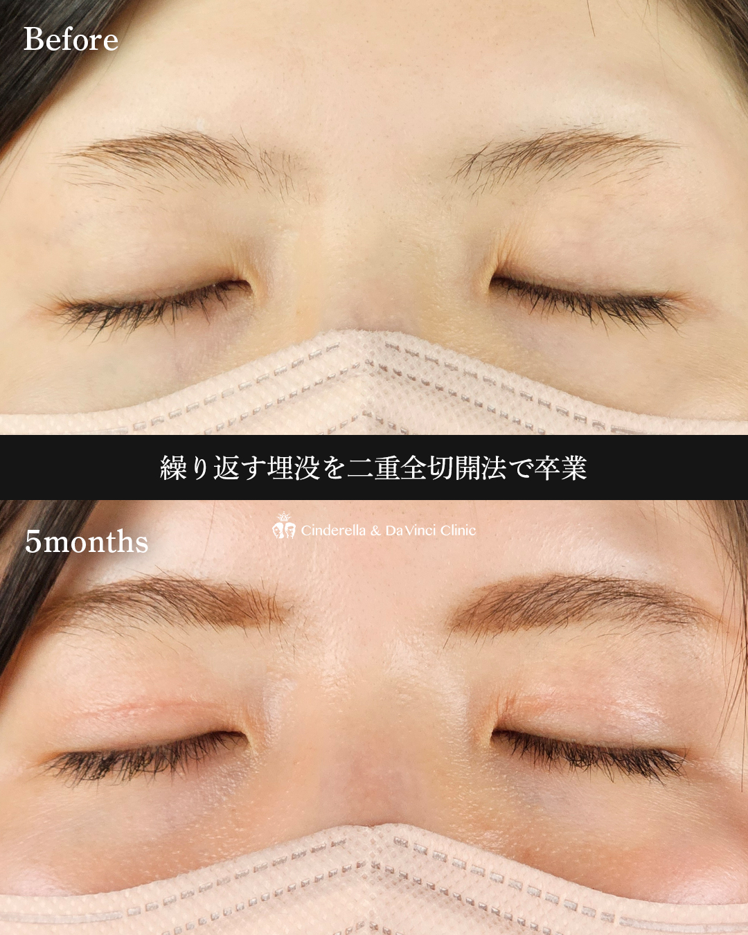 埋没から全切開への画像