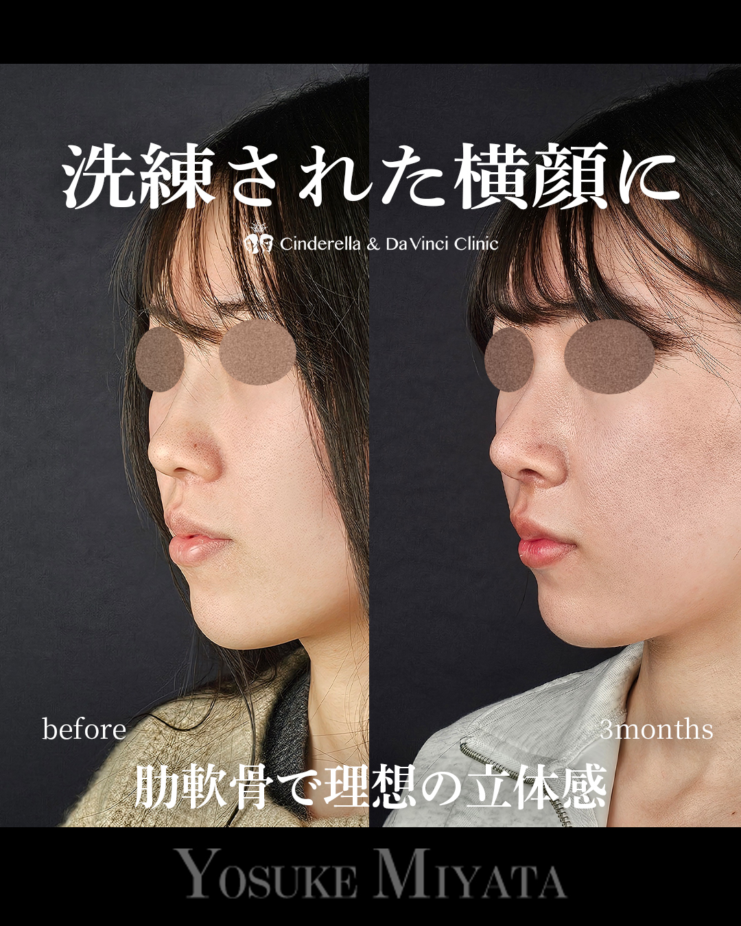 鼻整形で横顔をきれいにするの画像