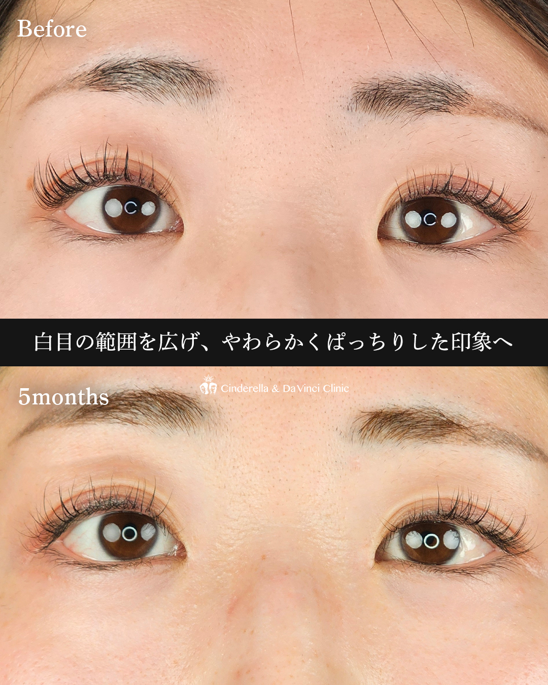 目頭切開とタレ目同時の画像