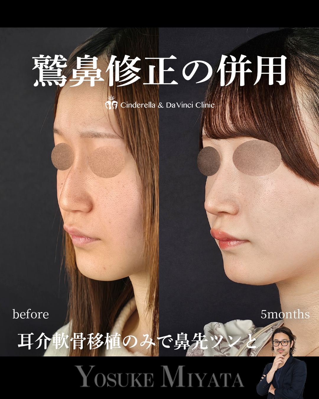 鷲鼻修正の併用の画像