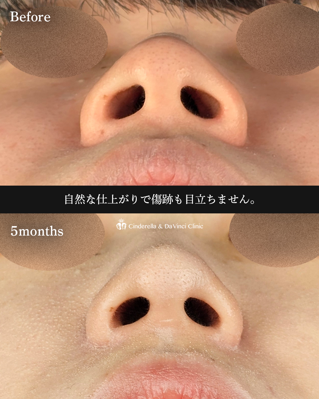 小鼻縮小のみで鼻の存在感をなくすの画像
