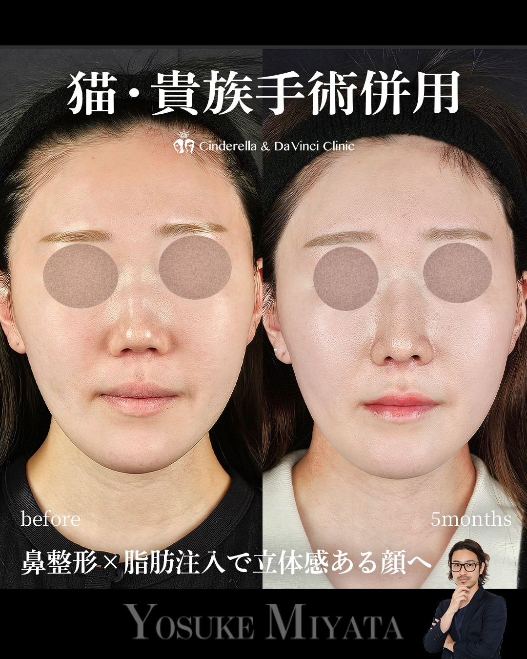 顔に立体感を出すの画像