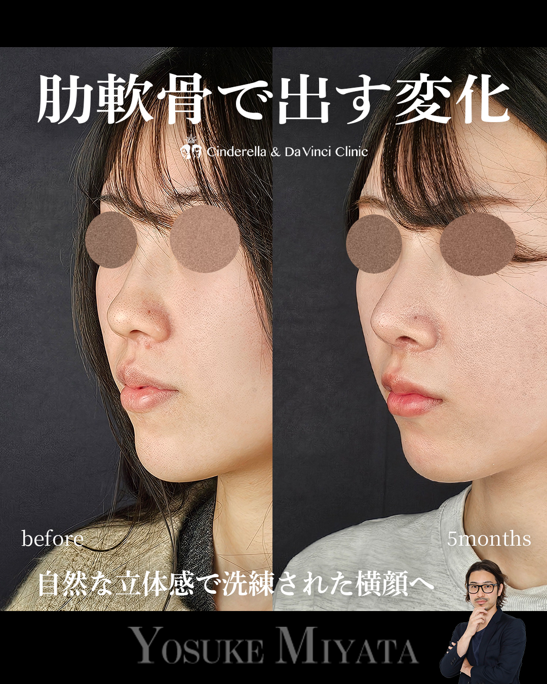 鼻整形で横顔をきれいにするの画像
