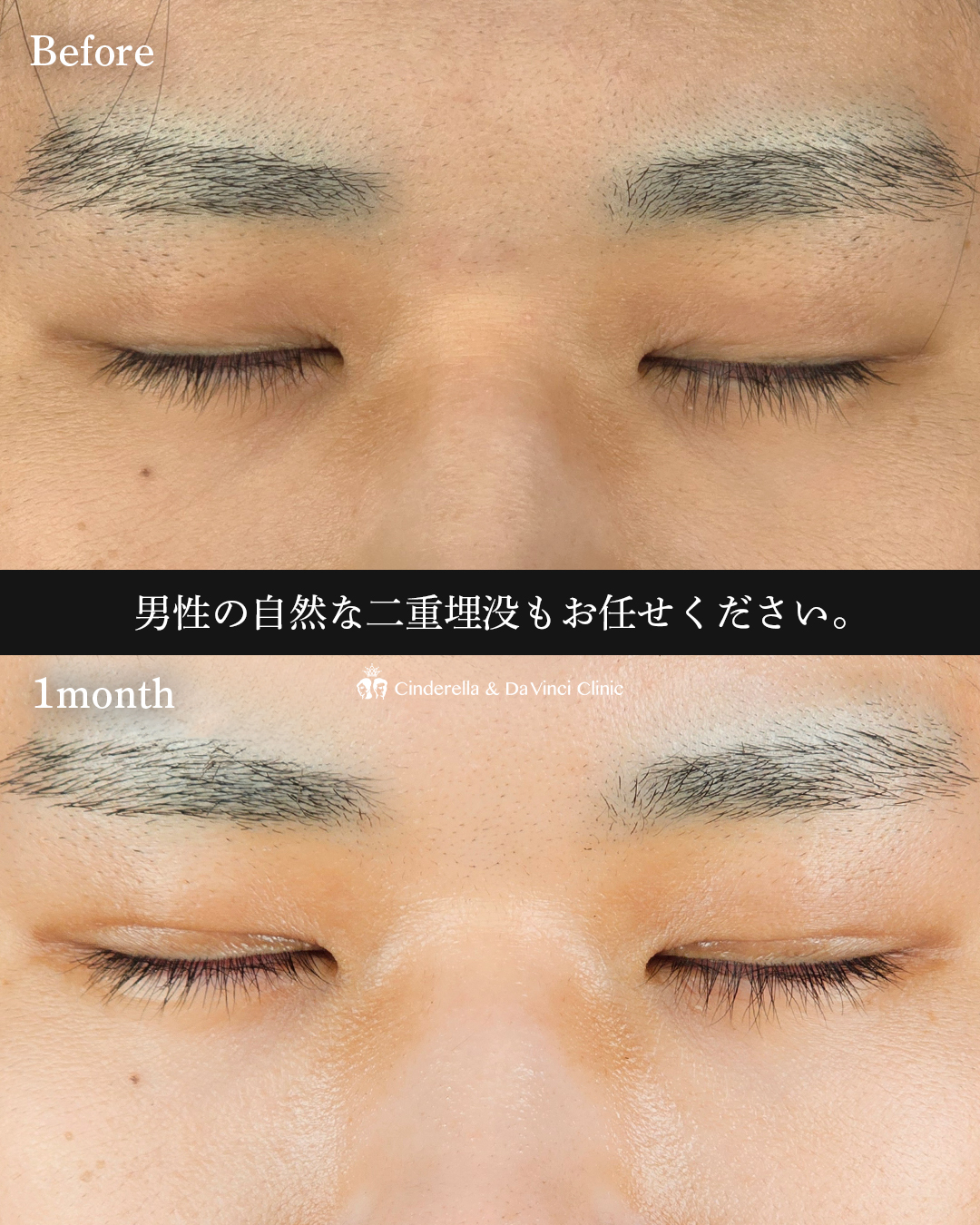 自然な二重埋没の画像