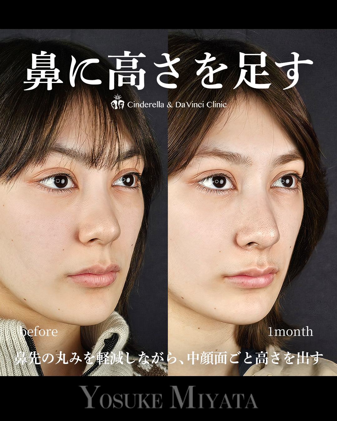 鼻に高さを足すの画像