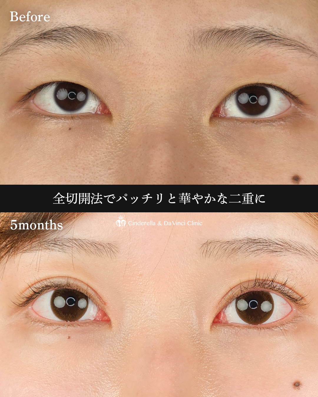 切開でつくる二重の画像