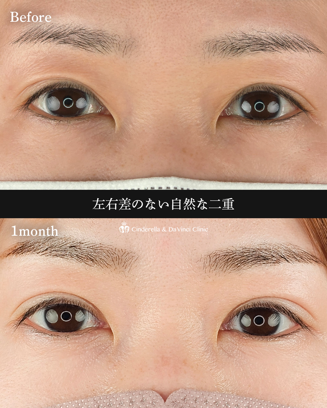 左右差の無い二重の画像