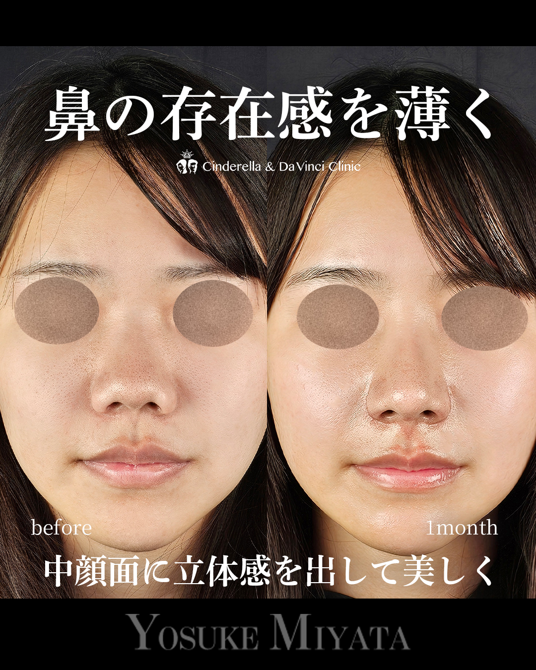 鼻の存在感を薄くの画像