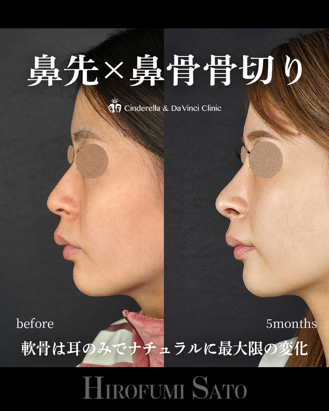 ナチュラルな鼻整形の画像