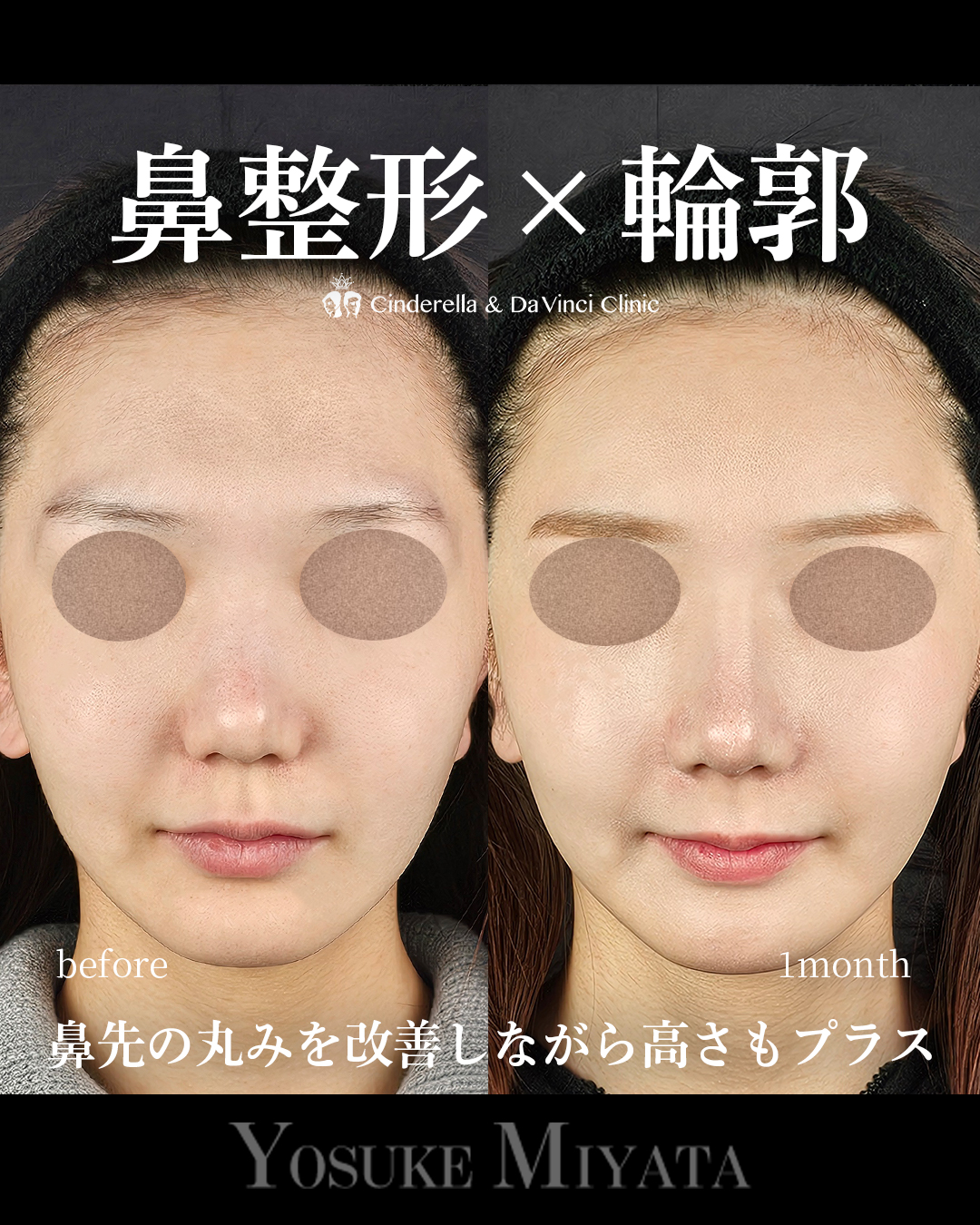 鼻整形×輪郭の画像