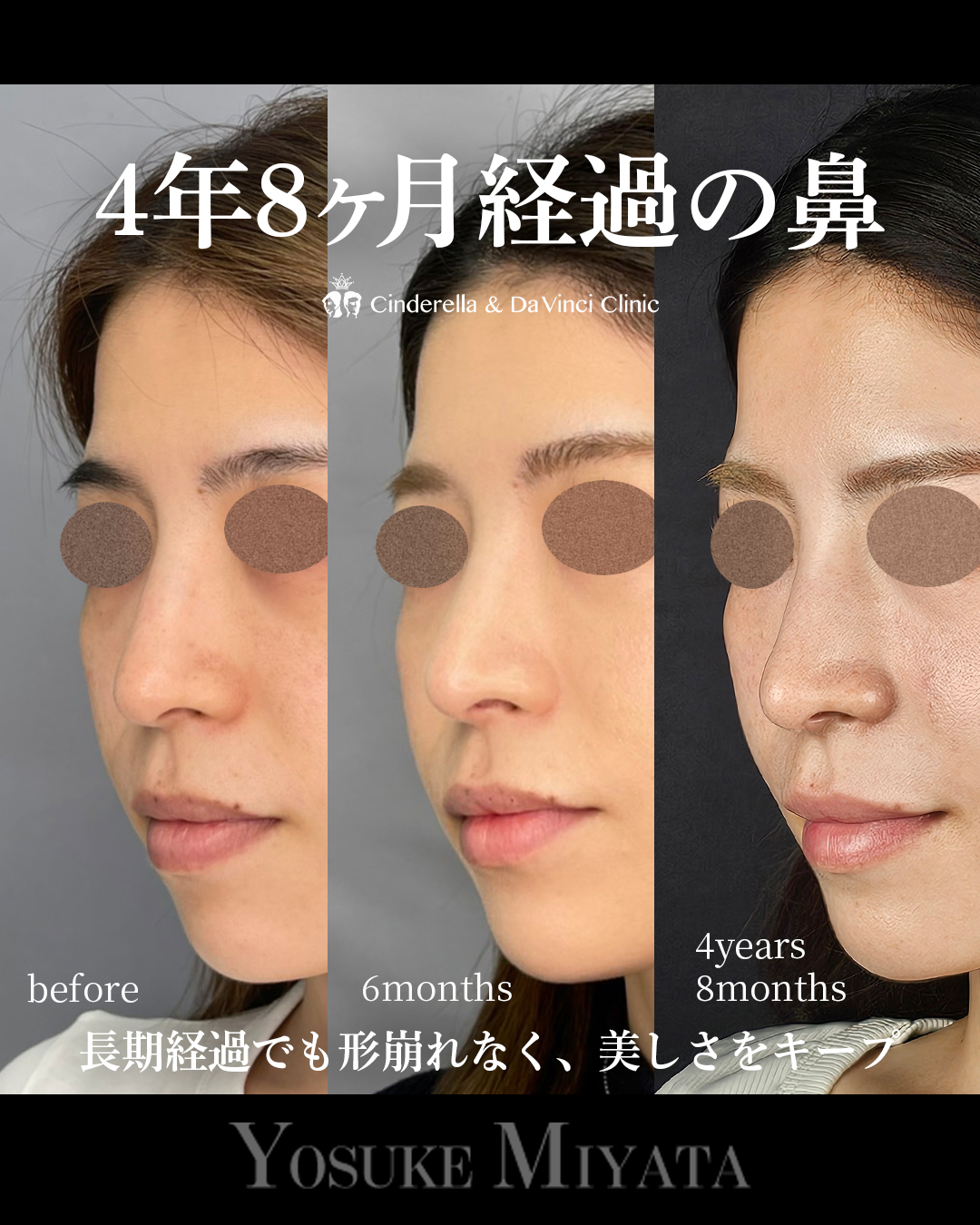 4年以上経過の鼻の画像