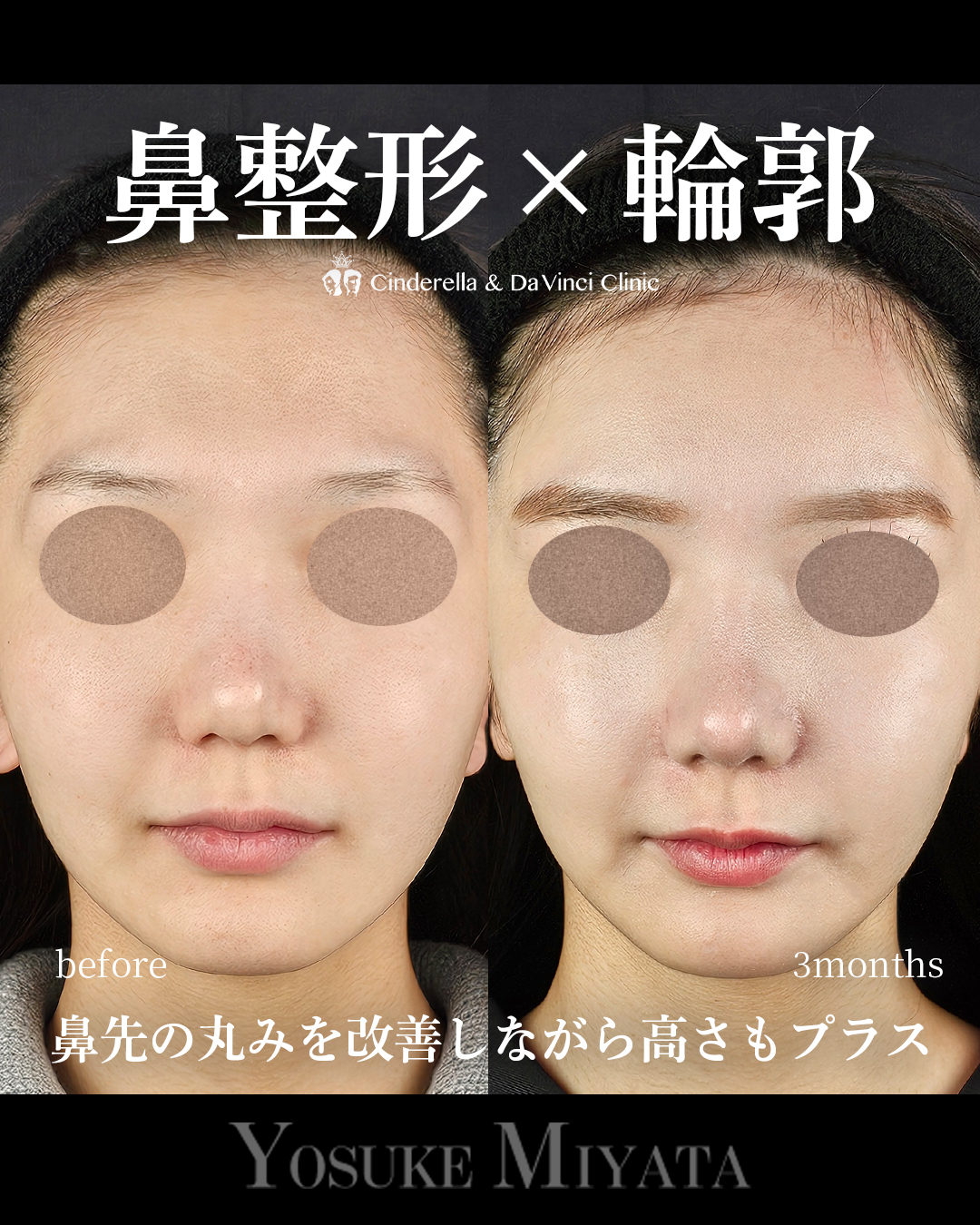 鼻整形×輪郭の画像